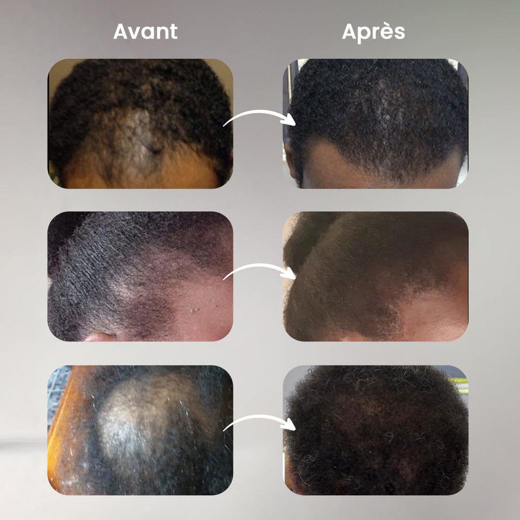 Fibres Capillaires pour la Perte de Cheveux